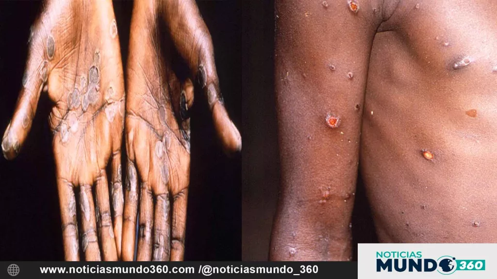 La OMS reactiva la Emergencia Internacional por la Viruela del Mono